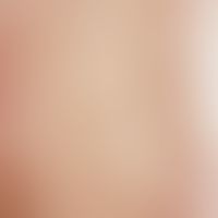 Erythema anulare centrifugum. 53 Jahre alter Patient mit Hautveränderungen seit mehreren Monaten....