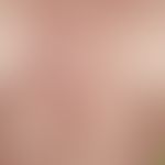 Erythema anulare centrifugum: multiple, chronisch aktive, zentrifugal wachsende, ubiquitäre (hier...