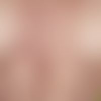 Erythema anulare centrifugum: multiple, chronically active, centrifugally growing, ubiquitous (he...