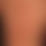 Erythema anulare centrifugum: Großflächige, polyzyklisch begrenzte,&nbsp;symptomlose&nbsp;Erythem...