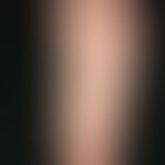 Erythema anulare rheumaticum. since birth, periodically and in connection with tonsillitis, fever...
