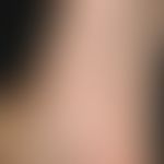 Erythema anulare rheumaticum. 1 cm in diameter, anular red spots with a slightly infiltrated eryt...