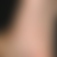 Erythema anulare rheumaticum. 1 cm in diameter, anular red spots with a slightly infiltrated eryt...