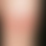 Erythema chronicum migrans:&nbsp;seit 14 Tagen (?) bestehende, schmerzlose, scharf begrenzte, run...