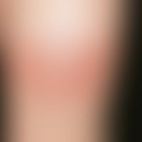 Erythema chronicum migrans, painless, sharply defined, round, red plaque with centrally located y...