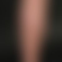 Erythema chronicum migrans. Seit etwa 8 Monaten peripher stetig wachsende, nur leicht konsistenzv...