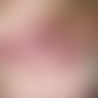 Erythema chronicum migrans. Kreisförmiges, langsam zentrifugal wachsendes, völlig symptomloses, r...