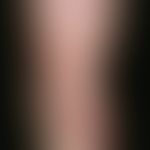 Erythema chronicum migrans. Hier abgebildet ist ein 3 Monate alter Befund. Ca. 10 Tage nach Zecke...