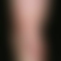 Erythema chronicum migrans. Hier abgebildet ist ein 3 Monate alter Befund. Ca. 10 Tage nach Zecke...