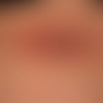 Erythema chronicum migrans: ovaler, langsam&nbsp;wachsender, völlig symptomloser&nbsp;rot-brauner...