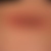 Erythema chronicum migrans: ovaler, langsam&nbsp;wachsender, völlig symptomloser&nbsp;rot-brauner...