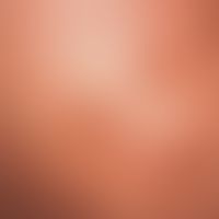 Erythema dyschromicum perstans. Schmutzig-graubräunliche, runde bis ovale Flecken am Rücken eines...