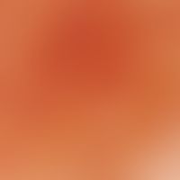Erythema dyschromicum perstans. Auflichtmikroskopie (Zentrum einer Läsion am Rücken eines 12-jähr...