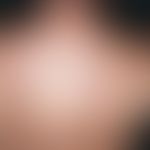 Erythema dyschromicum perstans. Seit Monaten bestehendes Krankheitsbild. Anfangs kleinfleckige, w...