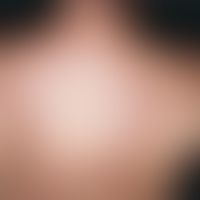 Erythema dyschromicum perstans. Seit Monaten bestehendes Krankheitsbild. Anfangs kleinfleckige, w...