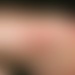 Erythema elevatum diutinum. Painful succulent nodules and plaques around the fingers. Previous vi...
