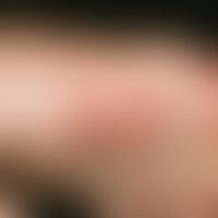 Erythema elevatum diutinum. Painful succulent nodules and plaques around the fingers. Previous vi...