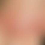 Erythema elevatum diutinum. for several months in different stages of acuity (partly somewhat fad...