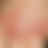 Erythema elevatum diutinum. for several months in different stages of acuity (partly somewhat fad...