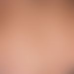 Erythema e calore. 53-year-old female patient, who regularly treated herself with long-lasting he...