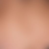 Erythema e calore. 53-year-old female patient, who regularly treated herself with long-lasting he...