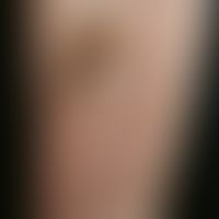 Erythema e calore. reticular erythema caused by frequent use of a heating pad with distinct hyper...