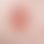Erythema multiforme: sharply defined, reddish plaque with central blister formation.
