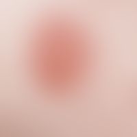 Erythema multiforme: sharply defined, reddish plaque with central blister formation.
