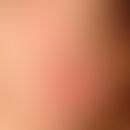 Erythema multiforme. 10-jährige Patientin mit Z.n. Herpes-simplex-Viren-Infektion vor 4 Wochen. M...