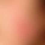 Erythema multiforme. 10-year-old female patient with Z.n. herpes simplex virus infection 4 weeks ...