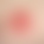 erythema multiforme: suddenly appeared, for 2 days existing, itchy, flat, cocard-like plaque on t...