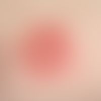 Erythema multiforme: plötzlich aufgetretene, seit 2 Tagen bestehende, juckende, flächige, kokarde...