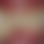 Erythema exsudativum multiforme. chronic dynamic erosive gingivitis with reactive squamous epithe...