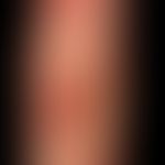 Erythema multiforme: typical picture with different stages of development of the efflorescences: ...