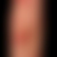 Erythema multiforme: typisches Bild mit unterschiedlichen Entwicklungsstufen der Effloreszenzen. ...