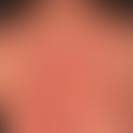 Erythema multiforme: 35-year-old female patient with Z.n. herpes simplex virus infection 4 weeks ...