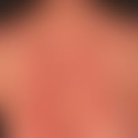 Erythema multiforme: 35-jährige Patientin mit Z.n. Herpes-simplex-Viren-Infektion vor 4 Wochen. M...