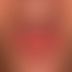 Erythema exsudativum multiforme, map-like, highly painful erosions of the tongue.
