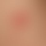 Erythema multiforme: in addition to a larger red plaque with central blister formation, a fresh, ...