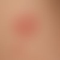 Erythema multiforme: in addition to a larger red plaque with central blister formation, a fresh, ...