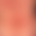 Erythema multiforme: 35-year-old female patient with Z.n. herpes simplex virus infection 4 weeks ...
