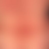 Erythema multiforme: 35-jährige Patientin mit Z.n. Herpes-simplex-Viren-Infektion vor 4 Wochen. M...