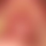 Erythema exsudativum multiforme; acutely opened, extensive, painful erosions of the oral mucosa; ...
