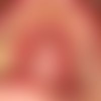 Erythema exsudativum multiforme; acutely opened, extensive, painful erosions of the oral mucosa; ...