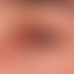 Erythema exsudativum multiforme; distinct conjunctivitis, inflammatory crusty changes of the eyel...