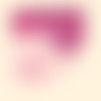 Erythema induratum. Spätstadium: Homogen dichte granulomatöse Entzündung. Septen des Fettgewebes ...