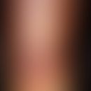 Erythema induratum. Die 52 Jahre alte Sekretärin leidet seit 3 Jahren an dieser, in Schüben verla...