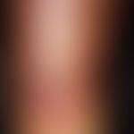 Erythema induratum. Die 52 Jahre alte Sekretärin leidet seit 3 Jahren an dieser, in Schüben verla...