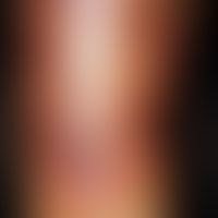 Erythema induratum. 52-year-old secretary has been suffering for 3 years from this moderately pai...