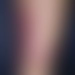 Erythema induratum. Entzündliche, mäßig schmerzhafte, rote bis braun-rote, subkutane Knoten und P...